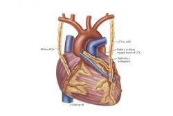 What is the Coronary Bypass Surgery Cost in Delhi?