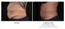 CoolSculpting Therapy Results