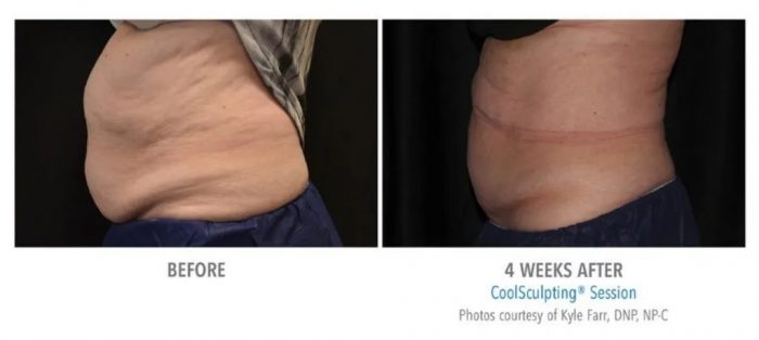 CoolSculpting Therapy Results