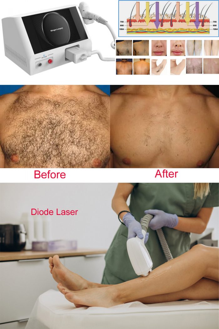 The scope of laser hair removal treatment