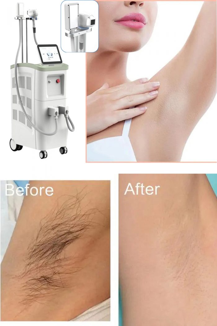 Do you know about laser hair removal?