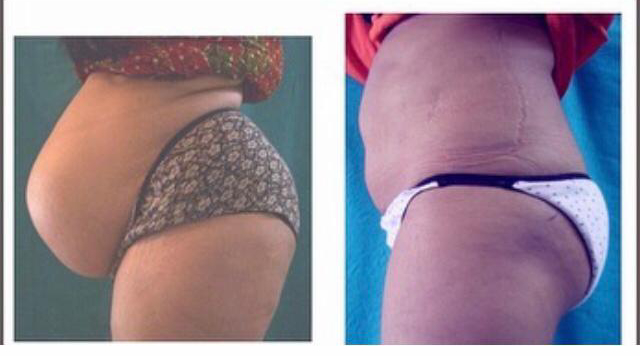 Get A Tummy Tuck…For A Wow Body Contour!