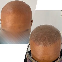 Get Alopecia Areata Treatment in Bangalore