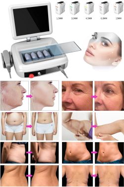 HIFU ultrasound facelift machine solves skin laxity and wrinkles