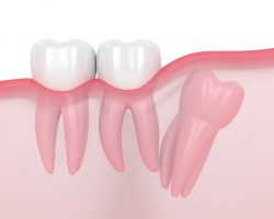 Need An Emergency Wisdom Tooth Removal | emergency same day wisdom tooth extraction