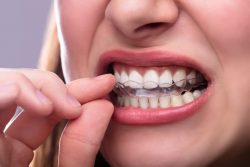 Teeth Grinding Treatment in Houston