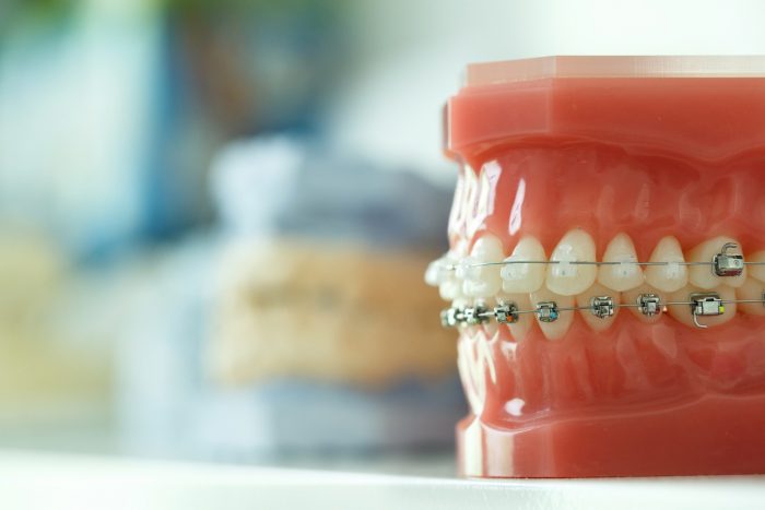 Braces Colors That Make Your Teeth Whiter