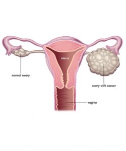 Ovarian cancer Doctors in Gurgaon