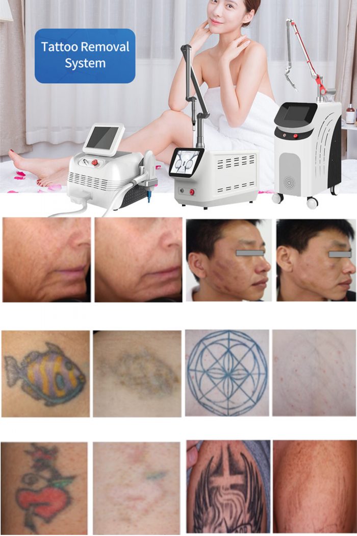The effect of picosecond laser spot removal