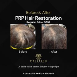 PRP Hair Restoration Los Alto