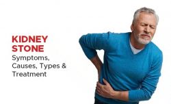 Kidney Stones – Symptoms, Causes, Types, and Treatment