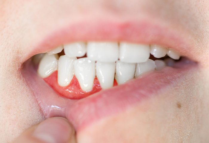 Dental Abscess Treatment Cost | Gum Abscess Treatment