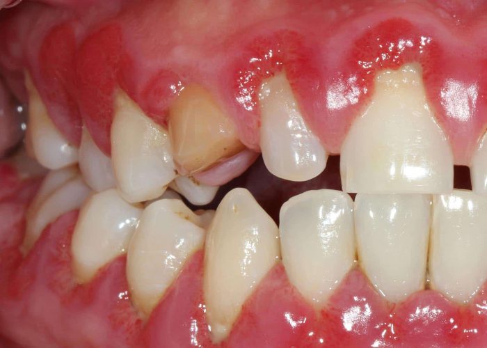 Dental Abscess Treatment | Gum Abscess Treatment in Houston