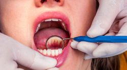 What Are The Benefits Of Teeth Cleaning? | teeth cleaning health benefits