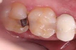 Do deep cavity fillings hurt? | Tooth Sensitivity After a Filling