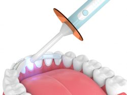 Teeth Bonding in Houston | Tooth Repair Near Me