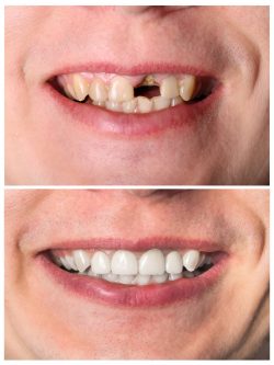Teeth Bonding Before And After | Cosmetic Bonding