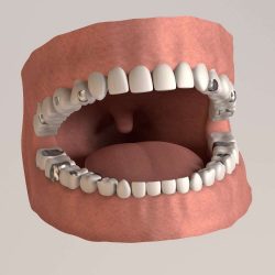 Affordable Dentures | Dentures Dentist Near Me