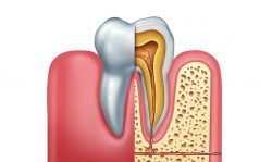 Root Canal Specialist Near Me | Root Canal Treatment Procedure