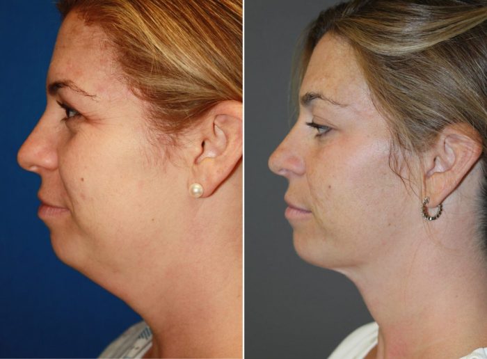 How Much Does a Neck Liposuction Cost | Double Chin Surgery