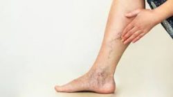 Are varicose veins covered by insurance?