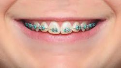 How To Find The Best Color For Your Braces