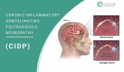 Chronic Inflammatory Demyelinating Polyradiculoneuropathy (CIDP)