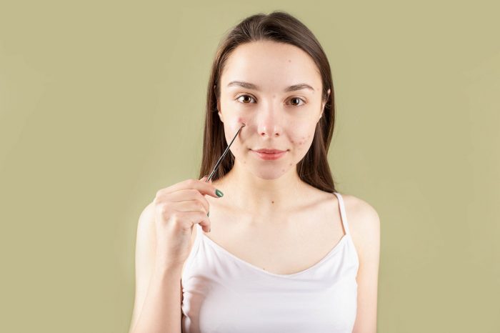 5 Tips for Dealing with Adult Acne:- Vivid Skin & Laser Centre