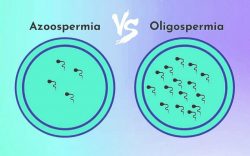 The Difference Between Oligospermia and Azoospermia