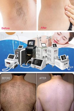 Safety and efficacy of laser hair removal