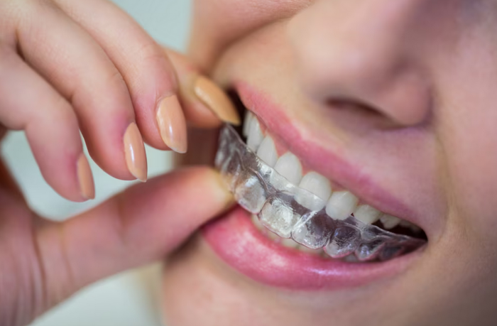 Get Your Perfect Smile with Invisalign Treatment