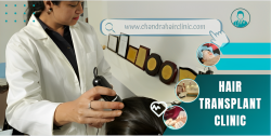 find best hair transplant clinic in Delhi