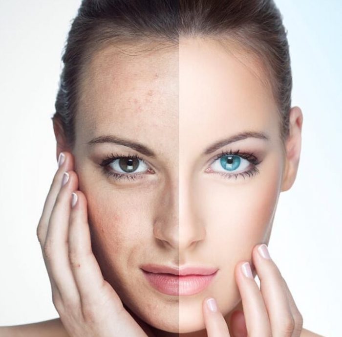 Laser Skin Treatment in Perth | Dermedica Cosmetic Clinic