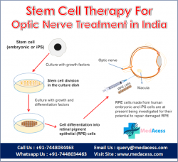 optic nerve atrophy treatment in India