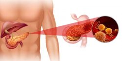 What You Should Know About Pancreatic Cancer Symptoms