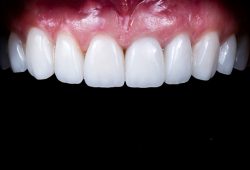 Porcelain Dental Veneer | Cosmetique Dental