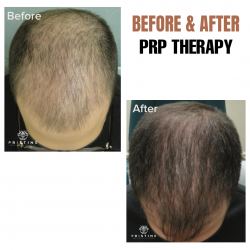 PRP Hair Loss Treatment Los Alto