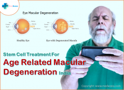 Stem cell age related macular degeneration treatment in India