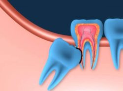 Impacted wisdom tooth Infection | Infected Wisdom Tooth