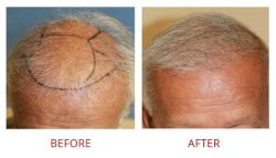 Best Hair Restoration Doctor near me | Beverly Hills Hair Restoration