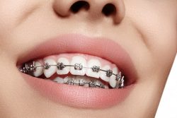 How long does it take to get your braces off?