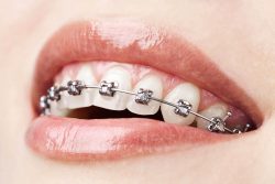 What causes bad breath while wearing braces or retainers
