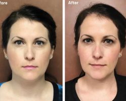 Say Goodbye to TMJ Pain with Botox Treatment: A Comprehensive Guide by Tatum Dentistry