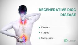 Degenerative Disk Disease: Stages, Causes, Symptoms and Treatment