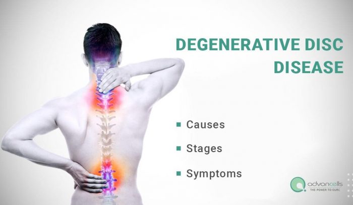 Degenerative Disk Disease Stages Causes Symptoms And Treatment