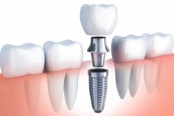 What are the Benefits of Getting Dental Implants?