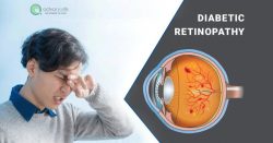 Diabetic Retinopathy – Symptoms, Causes, Stages, and Treatment