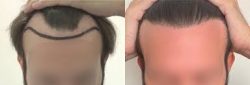 After and Before Result – Best Hair transplant in Delhi