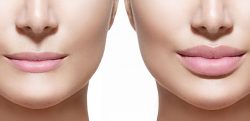Get Plumper and More Attractive with Lip Augmentation Surgery in delhi