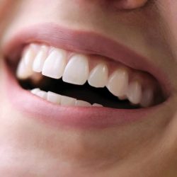 Porcelain Veneers Cost For A Perfect Smile Transformation